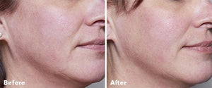 AnteAGE Home Microneedling Solution Kit